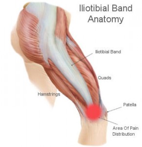 ITband syndrome